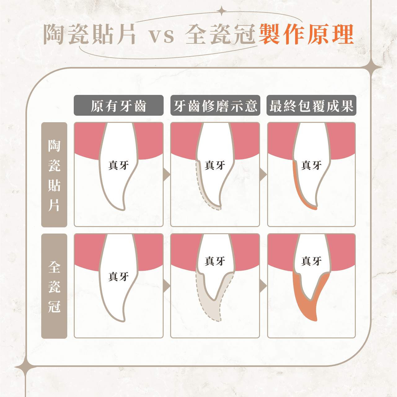 全瓷冠 vs 陶瓷貼片製作原理