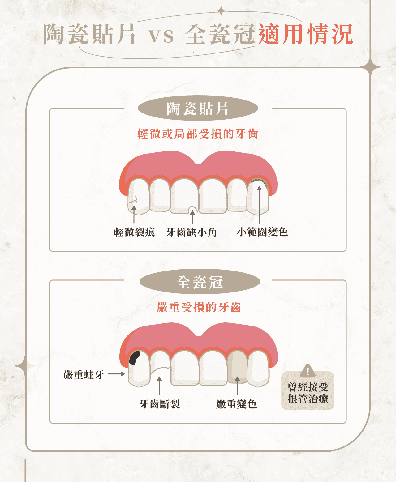 全瓷冠 vs 陶瓷貼片適用情況